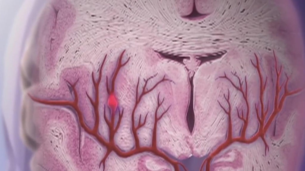 Knowing the signs of a stroke can save lives — Acworth Community news